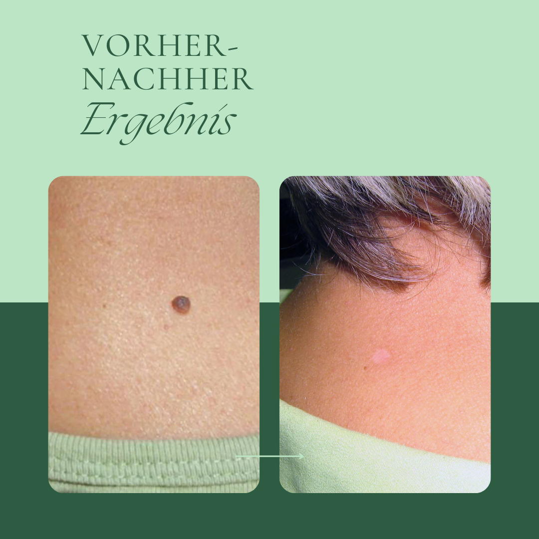 Creamole - Pflanzliche Creme zur Entfernung von Muttermalen, Leberflecken & Co.
