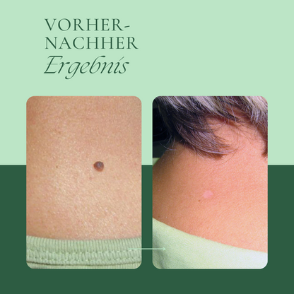 Creamole - Pflanzliche Creme zur Entfernung von Muttermalen, Leberflecken & Co.