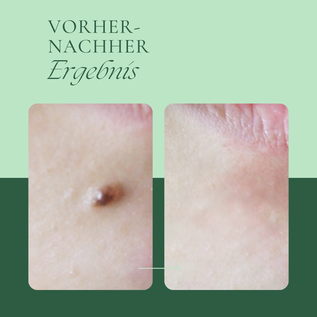Creamole - Pflanzliche Creme zur Entfernung von Muttermalen, Leberflecken & Co.