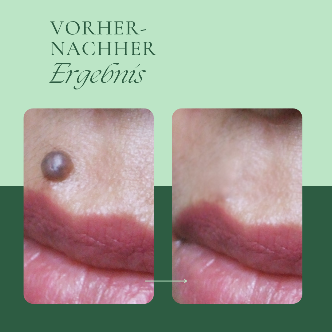 Creamole - Pflanzliche Creme zur Entfernung von Muttermalen, Leberflecken & Co.