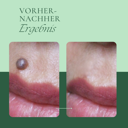 Creamole - Pflanzliche Creme zur Entfernung von Muttermalen, Leberflecken & Co.