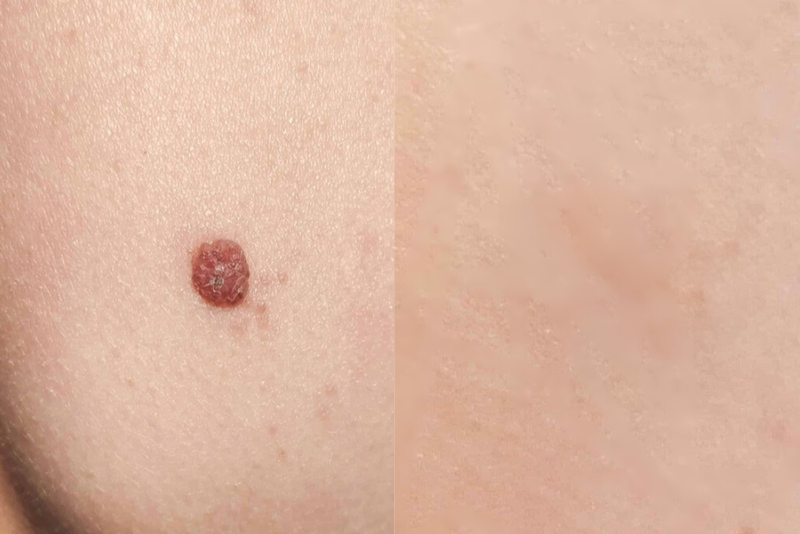Creamole – Natürliche Creme zur ästhetischen Behandlung von Muttermalen, Leberflecken & Co.